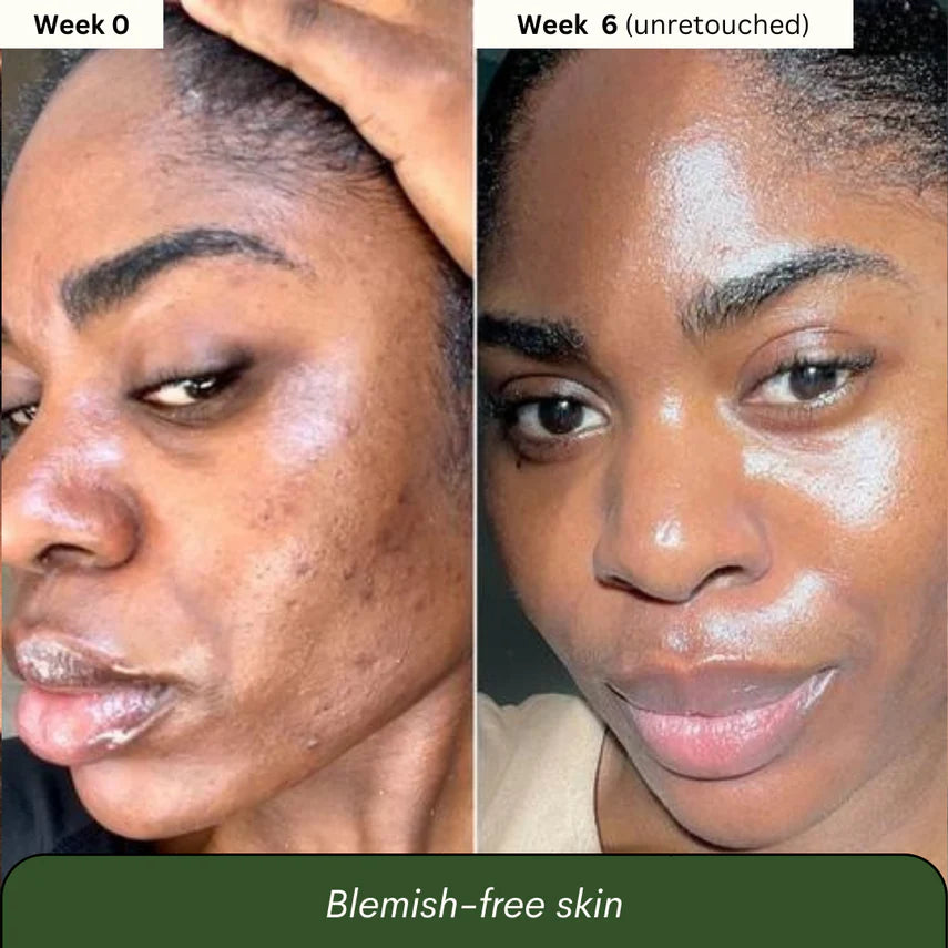 Advanced Turmeric & Kojic Acid Soap